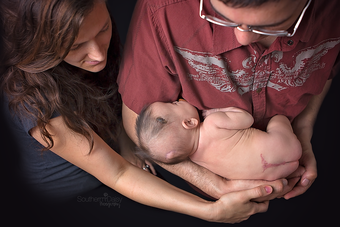 Baby born with spina bifida